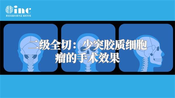 二级全切：少突胶质细胞瘤的手术效果