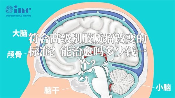 符合高级别胶质瘤改变的标准？能治愈吗多少钱一个？
