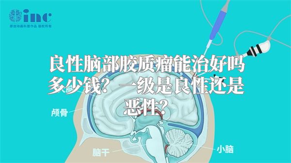 良性脑部胶质瘤能治好吗多少钱？一级是良性还是恶性？