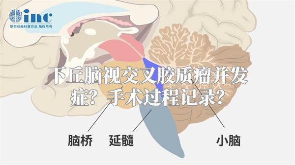 下丘脑视交叉胶质瘤并发症？手术过程记录？