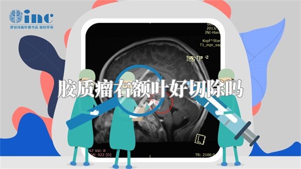 胶质瘤右额叶好切除吗