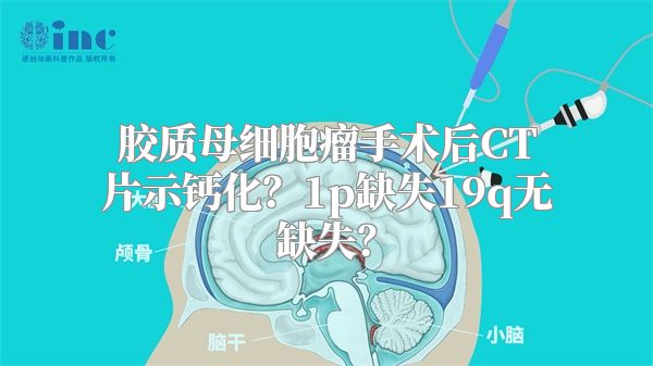 胶质母细胞瘤手术后CT片示钙化？1p缺失19q无缺失？