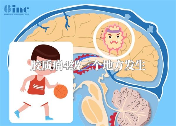 胶质瘤4级三个地方发生