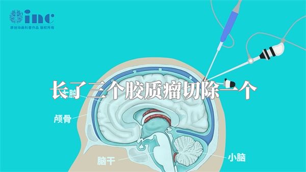 长了三个胶质瘤切除一个