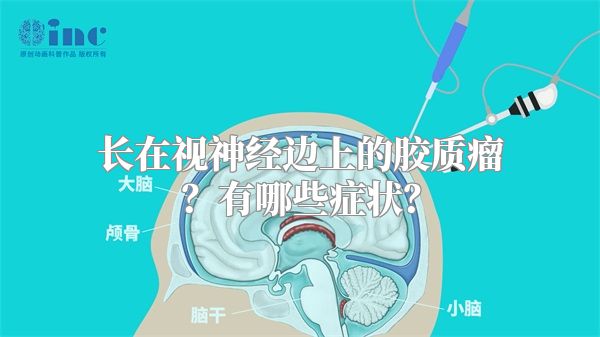 长在视神经边上的胶质瘤？有哪些症状？