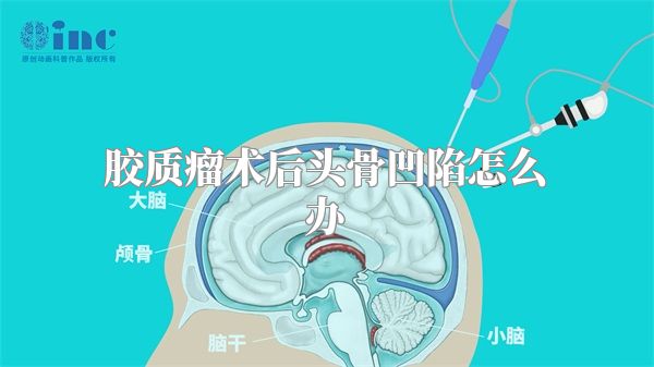 胶质瘤术后头骨凹陷怎么办