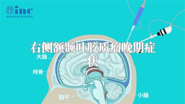 右侧额颞叶胶质瘤晚期症状