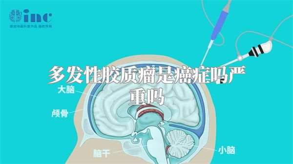 多发性胶质瘤是癌症吗严重吗