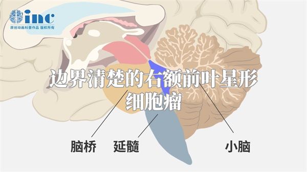 边界清楚的右额前叶星形细胞瘤