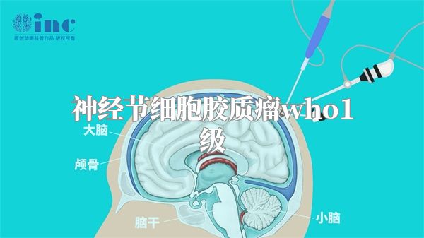 神经节细胞胶质瘤who1级