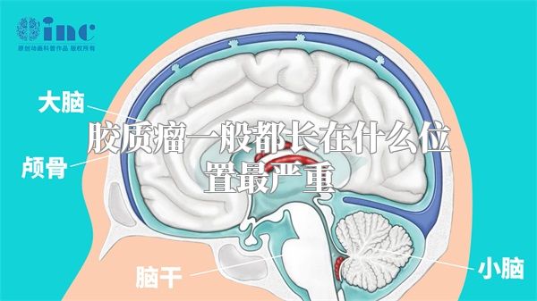 胶质瘤一般都长在什么位置最严重