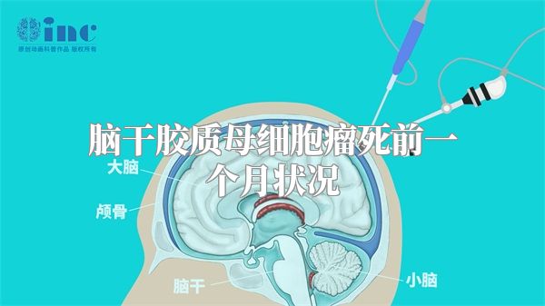 脑干胶质母细胞瘤死前一个月状况