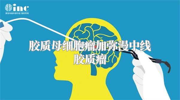 胶质母细胞瘤加弥漫中线胶质瘤