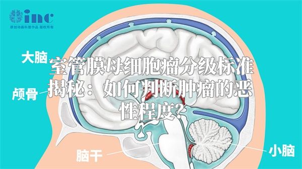 室管膜母细胞瘤分级标准揭秘：如何判断肿瘤的恶性程度？