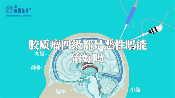 胶质瘤四级都是恶性吗能治好吗