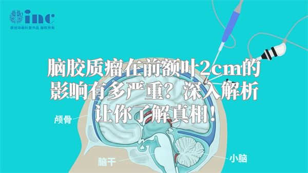 脑胶质瘤在前额叶2cm的影响有多严重？深入解析让你了解真相！