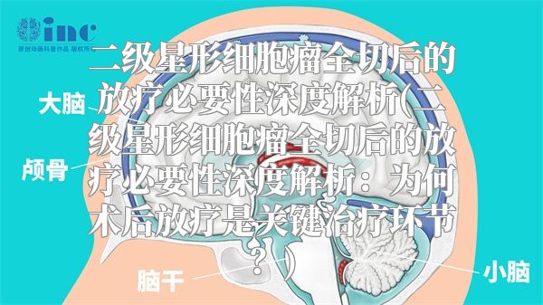 二级星形细胞瘤全切后的放疗必要性深度解析(二级星形细胞瘤全切后的放疗必要性深度解析：为何术后放疗是关键治疗环节？)