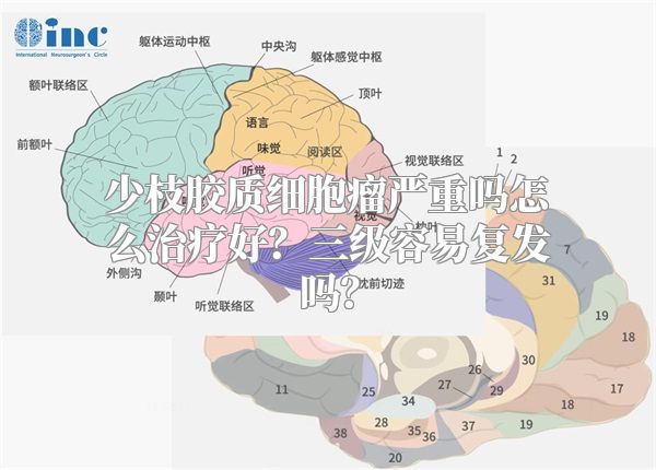 少枝胶质细胞瘤严重吗怎么治疗好？三级容易复发吗？