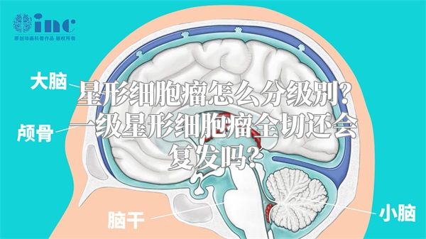 星形细胞瘤怎么分级别？一级星形细胞瘤全切还会复发吗？