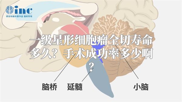 一级星形细胞瘤全切寿命多久？手术成功率多少啊？