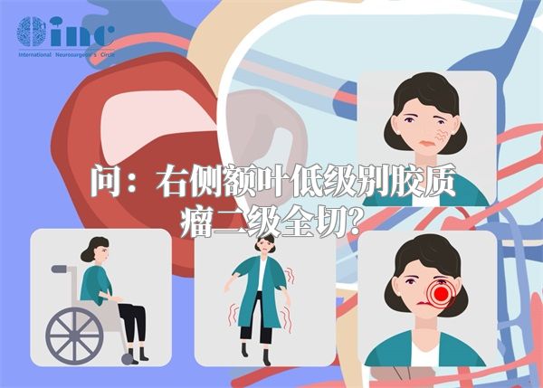 问：右侧额叶低级别胶质瘤二级全切？