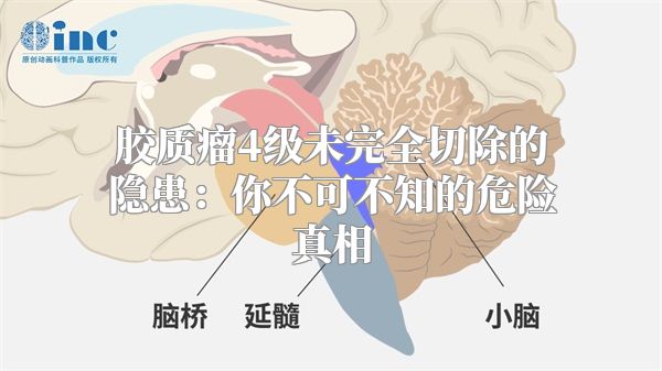 胶质瘤4级未完全切除的隐患：你不可不知的危险真相