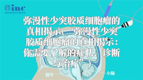弥漫性少突胶质细胞瘤的真相揭示(“弥漫性少突胶质细胞瘤的真相揭示：你需要了解的症状、诊断与治疗”)