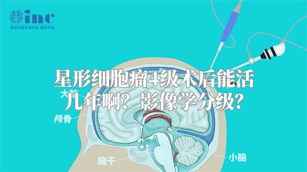 星形细胞瘤4级术后能活几年啊？影像学分级？
