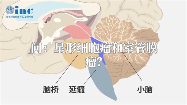 问：星形细胞瘤和室管膜瘤？