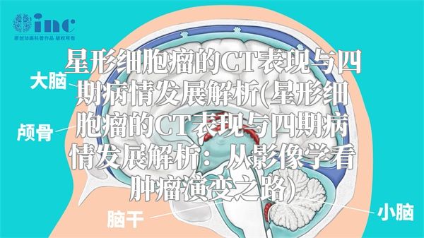 星形细胞瘤的CT表现与四期病情发展解析(星形细胞瘤的CT表现与四期病情发展解析：从影像学看肿瘤演变之路)