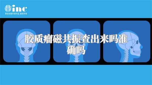 胶质瘤磁共振查出来吗准确吗