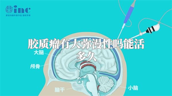 胶质瘤有大弥漫性吗能活多久