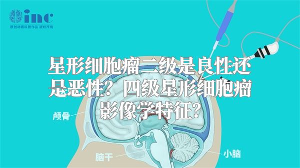 星形细胞瘤二级是良性还是恶性？四级星形细胞瘤影像学特征？
