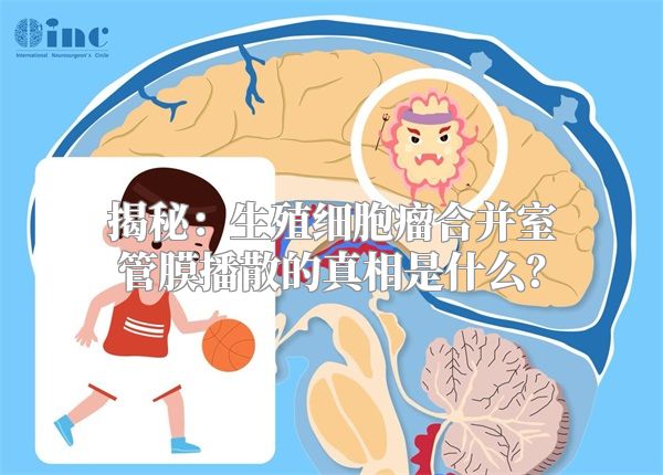 揭秘：生殖细胞瘤合并室管膜播散的真相是什么？