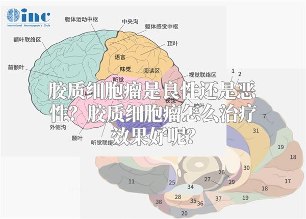 胶质细胞瘤是良性还是恶性？胶质细胞瘤怎么治疗效果好呢？
