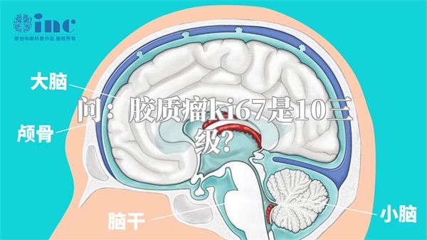 问：胶质瘤ki67是10三级？