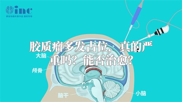 胶质瘤多发占位，真的严重吗？能否治愈？