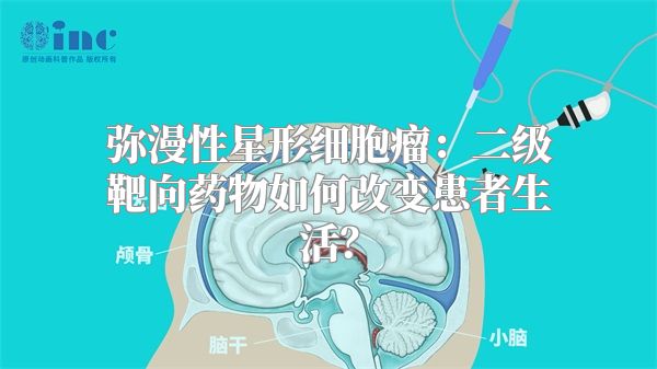 弥漫性星形细胞瘤：二级靶向药物如何改变患者生活？