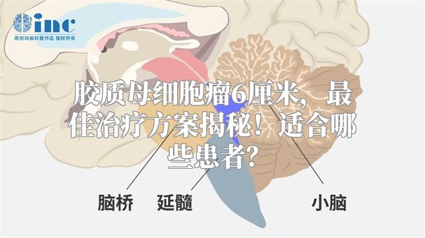 胶质母细胞瘤6厘米，最佳治疗方案揭秘！适合哪些患者？