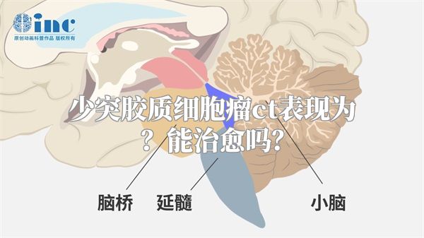 少突胶质细胞瘤ct表现为？能治愈吗？