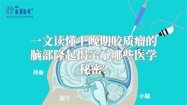 一文读懂丨晚期胶质瘤的脑部隆起揭示了哪些医学秘密？