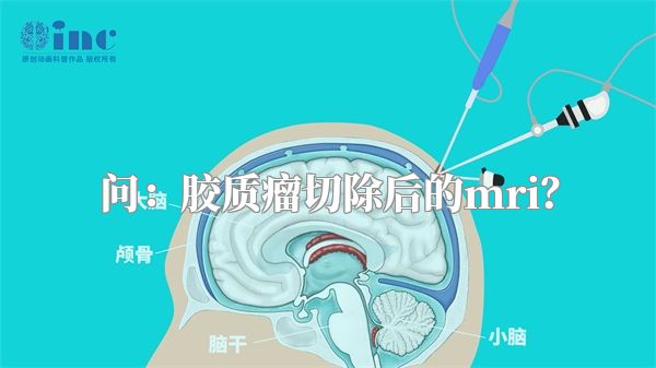 问：胶质瘤切除后的mri？