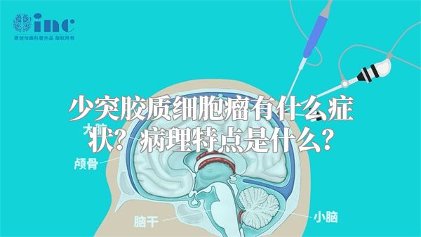 少突胶质细胞瘤有什么症状？病理特点是什么？