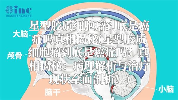 星型胶质细胞瘤到底是癌症吗真相揭秘(星型胶质细胞瘤到底是癌症吗？真相揭秘：病理解析与治疗现状全面剖析！)