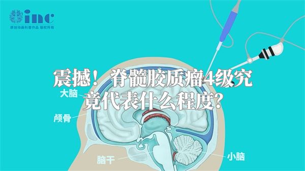 震撼！脊髓胶质瘤4级究竟代表什么程度？