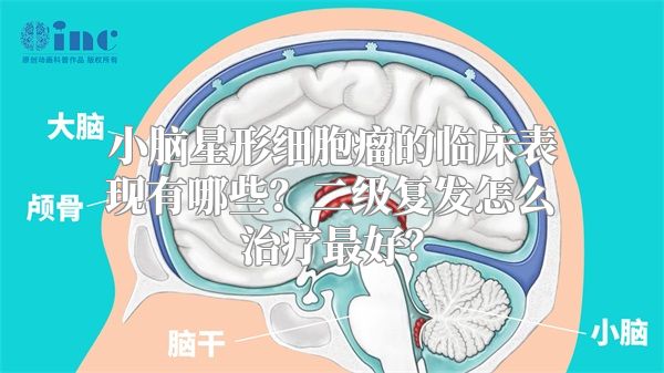 小脑星形细胞瘤的临床表现有哪些？二级复发怎么治疗最好？