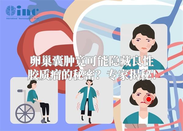 卵巢囊肿竟可能隐藏良性胶质瘤的秘密？专家揭秘！