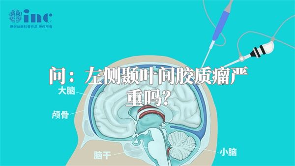 问：左侧颞叶间胶质瘤严重吗？