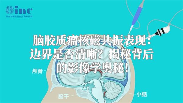 脑胶质瘤核磁共振表现：边界是否清晰？揭秘背后的影像学奥秘！