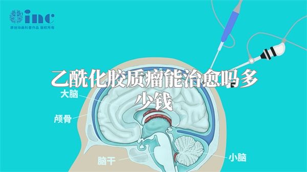 乙酰化胶质瘤能治愈吗多少钱